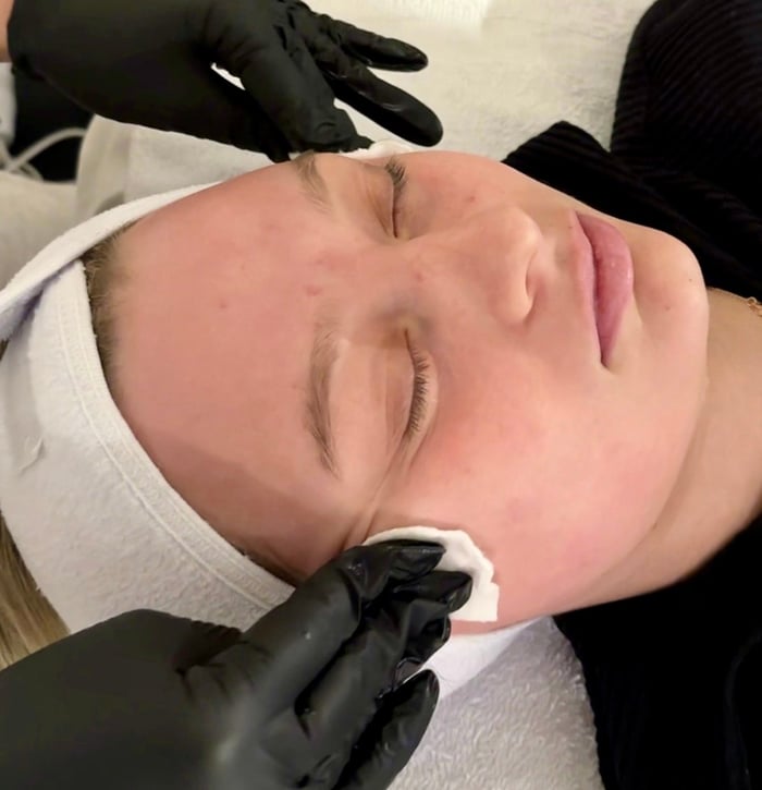 Reparative Chemical Peel image