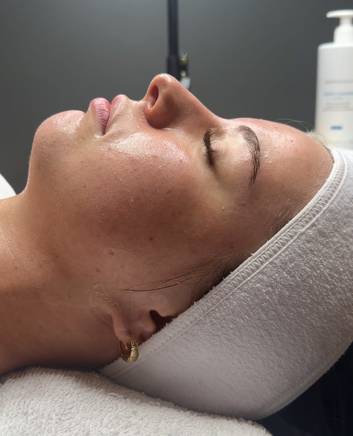 Acne Facial image